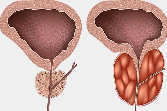 Vnetje prostate