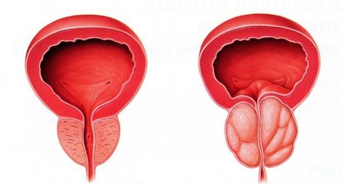 Zdrava in vneta prostata s kroničnim prostatitisom