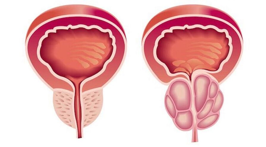 Zdrava in vneta prostata s prostatitisom