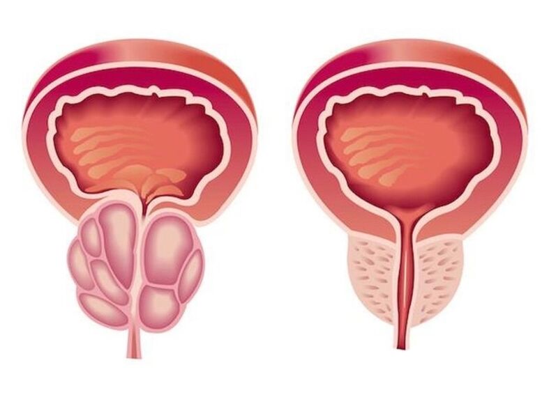 Kako izgleda prostatitis